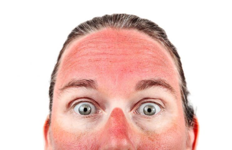 Woman-with-sunburn-e1463957928597.jpg